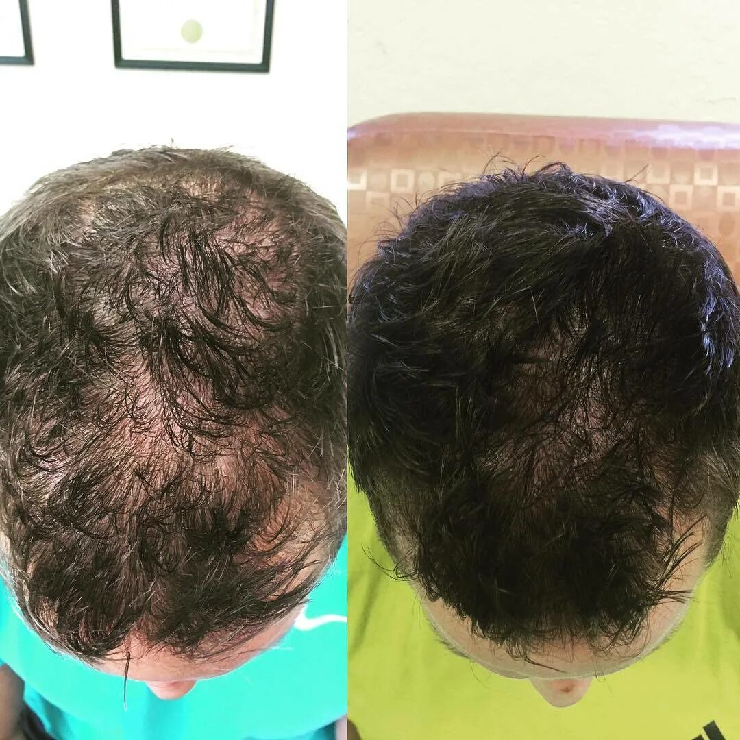 Восстановление выпадения волос. Плазмолифтинг алопеция. Плазмолифтинг для волос. Плазмотерапия для волос до и после. Плахма терапи для волос.