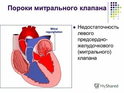 Комбинированный порок клапана
