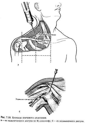 Блокада сплетения. Блокада плечевого сплетения по Куленкампфу. Надключичная блокада плечевого сплетения. Блокада плечевого сплетения надключичным способом. Аксиллярная блокада плечевого сплетения.