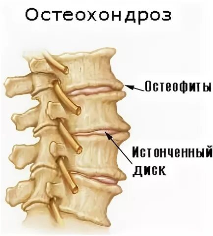Остеофиты костные наросты позвоночника. Костные наросты остеофиты. Остеофиты позвоночника l1-s1. Что такое краевые остеофиты на позвоночнике. Остеофиты позвоночника рентген.