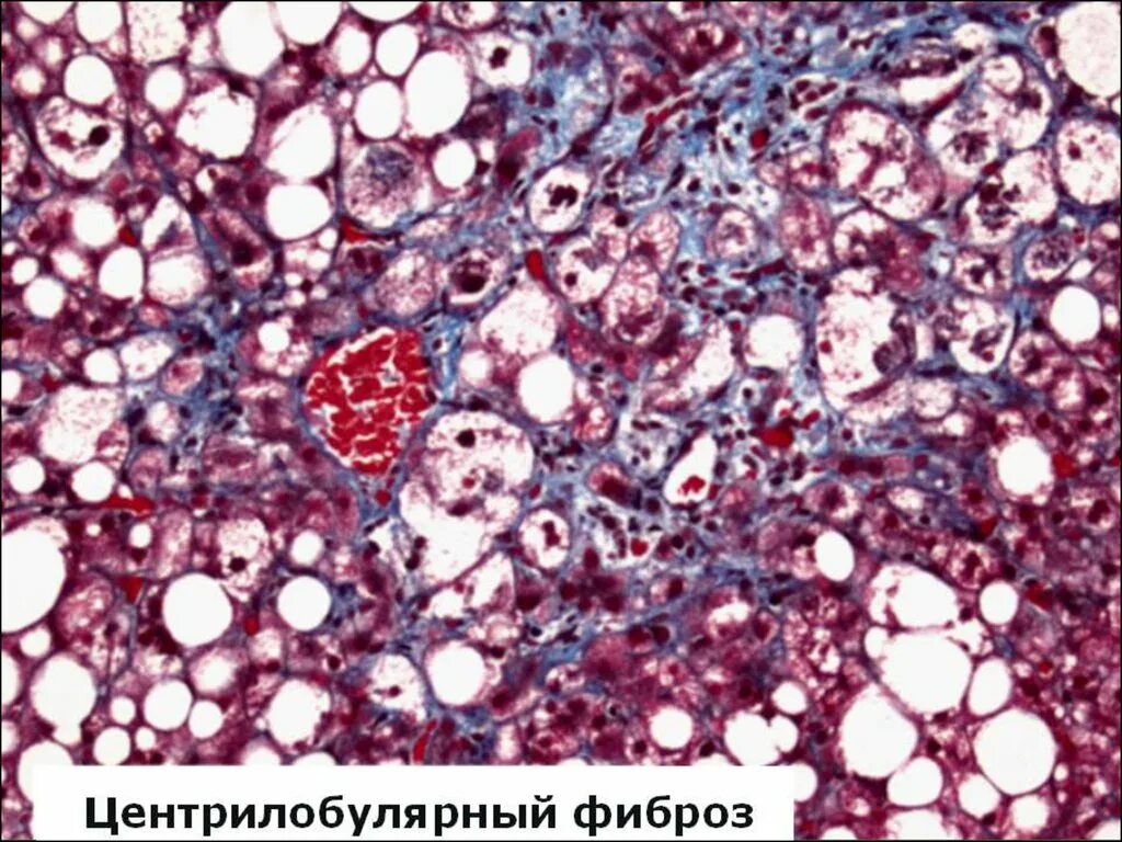 Клетки печени разрушаются. Перицеллюлярный фиброз. Периканальцевый фиброз. Фиброз печени картинки.