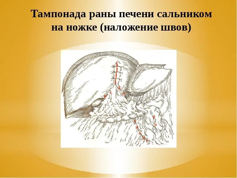 Тампонада раны при кровотечении. Наложение тампонады раны.