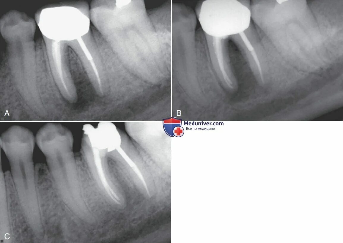 Восстановление после эндодонтического лечения. Периапикальная рентгенография. Схема эндодонтического лечения. Разрежение костной ткани в периапикальной области. Остеосклероз после эндодонти.