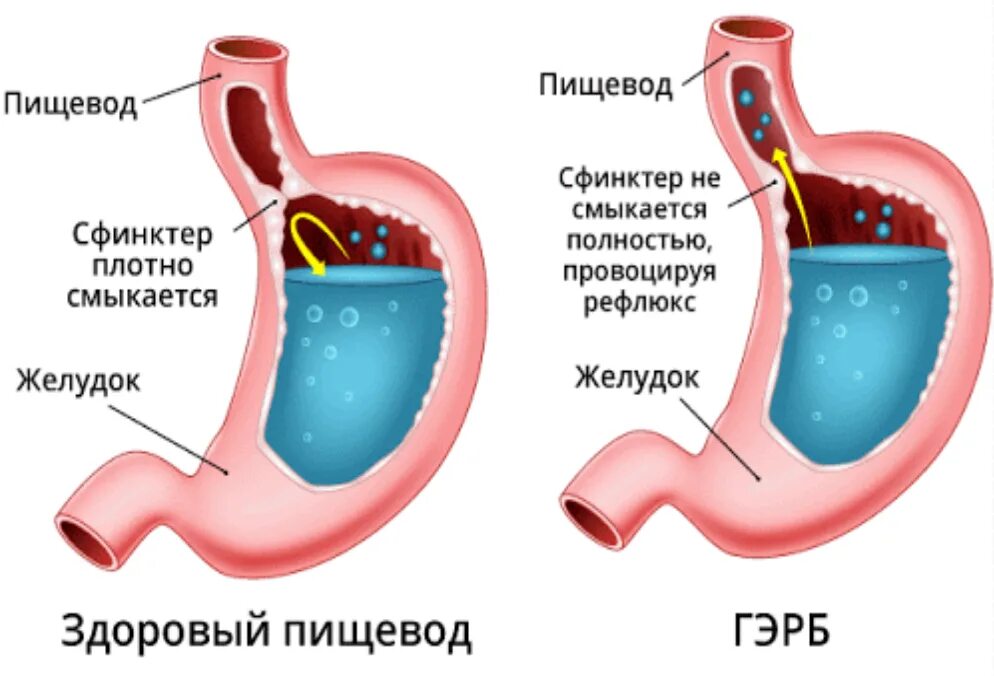 Поднимается пищевод. Внепищеводный рефлюкс эзофагит. Эзофагит рефлюкс кислотный. Недостаточность кардии ГЭРБ. Поверхностный гастрит рефлюкс эзофагит.