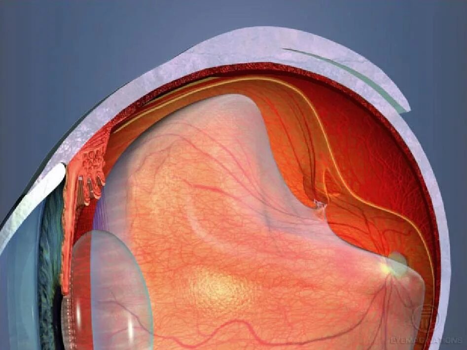 Тракционно-регматогенная отслойка сетчатки. Неопластическая отслойка сетчатки. Пузыревидная отслойка сетчатки. Клапанный разрыв отслойка сетчатки. Повреждение сетчатки