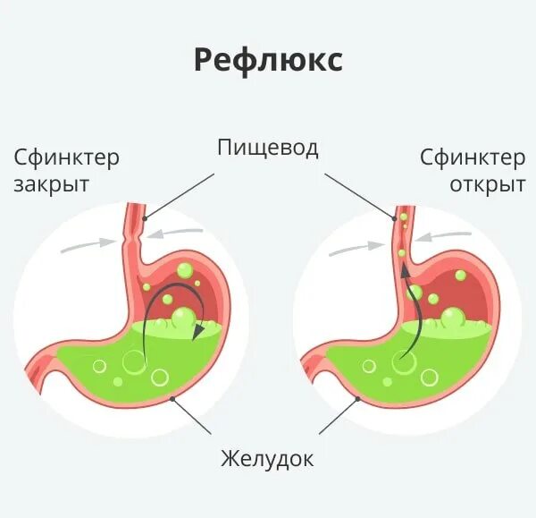 Ларингофарингеальный рефлюкс. При забросе желчи в пищевод.