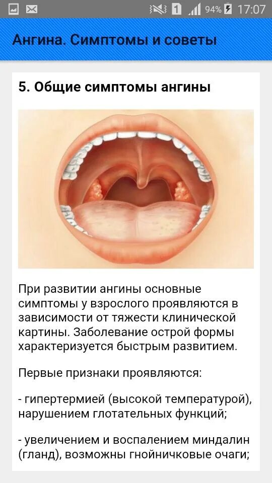 Может ли при ангине быть кашель