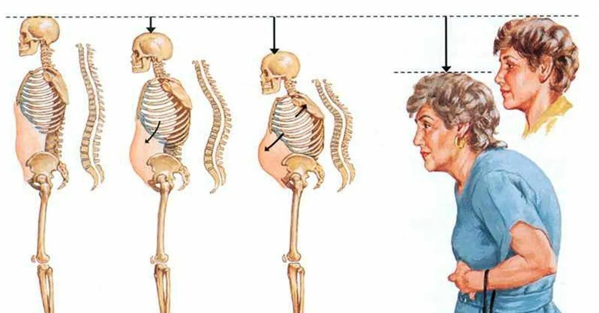Остеопороз. Опорно двигательный аппарат. Остеопороз у пожилых. Изменения опорно-двигательного аппарата. Признак возрастных изменений костей