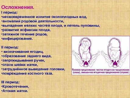 Виды тазового предлежания плода