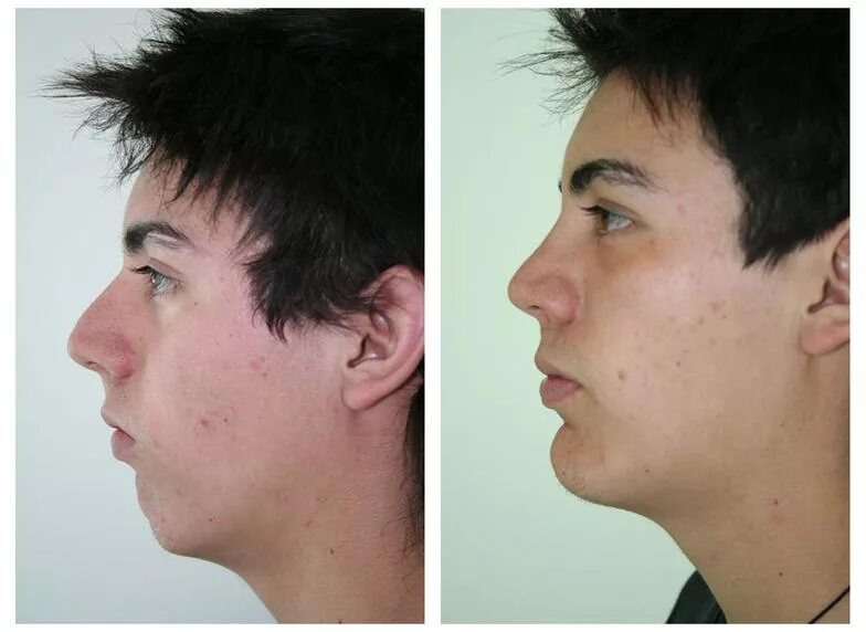 Разрез глаз пластическая хирургия. Трансплантация волос до и после. Нос картошкой у мужчин. Операция по изменению голоса. Операция по изменению голоса.