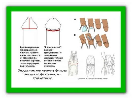 Открытие крайней плоти у детей. Внешняя плоть у мальчиков. Не открывается головка у мальчика. Можно ли с открытое головкой