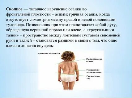 Сколиоз группа здоровья