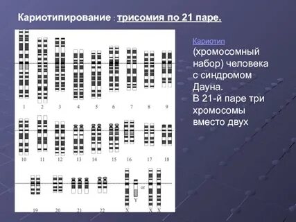 Трисомия 21 пары