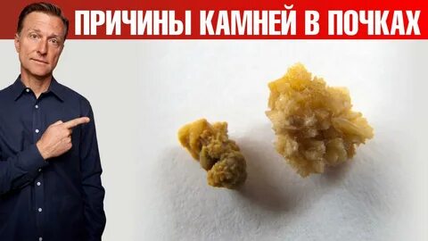 Обнаружена главная причина камней в почках ? - смотреть видео онлайн от "Dr. Ber