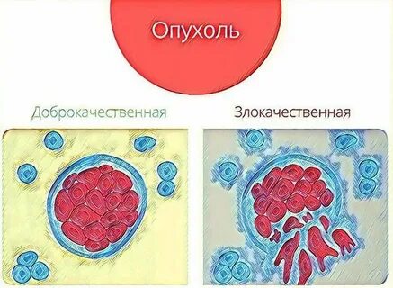 Доброкачественная и злокачественная