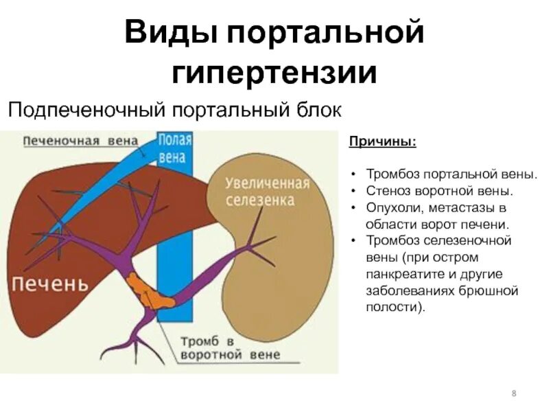 Портальная гипертензия подпеченочный блок. K76.6 портальная гипертензия. Пресинусоидальная портальная гипертензия. Причины подпеченочной портальной гипертензии. Расширение селезеночной вены