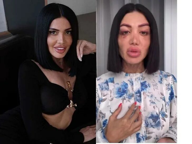 Оксана овсепян дом 2. Оксана овсепян до и после. Оксана овсепян косметолог. Овсепян после пластики. Оксана овсепян до и после пластики.