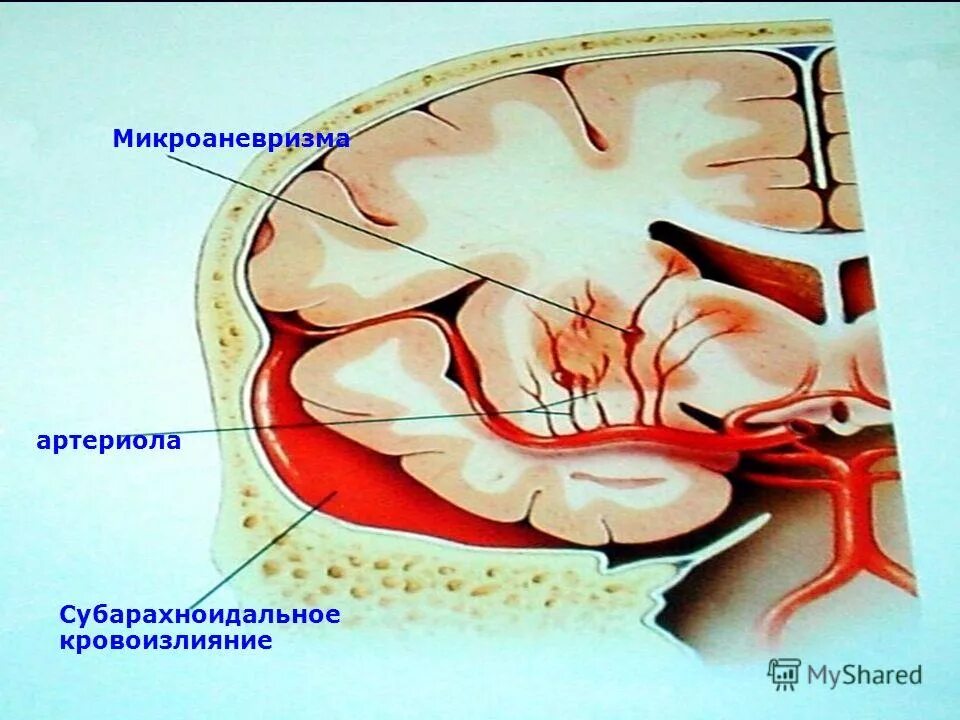 Субарахноидальное кровоизлияние в базальных цистернах. Подпаутинное субарахноидальное пространство. Субарахноидально-паренхиматозное кровоизлияние кт. Субарахноидальное кровотечение ликвор. Травматическое кровоизлияние