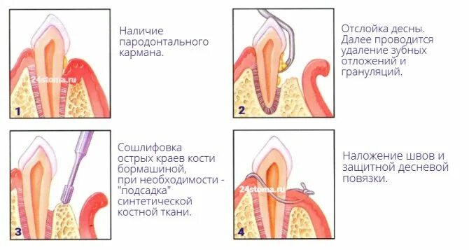 Зубной карман. Кюретаж пародонтальных карманов закрытый и открытый. открытый кюретаж пародонтальных карманов. лоскутная операция открытый кюретаж. лоскутная операция пародонтального кармана.
