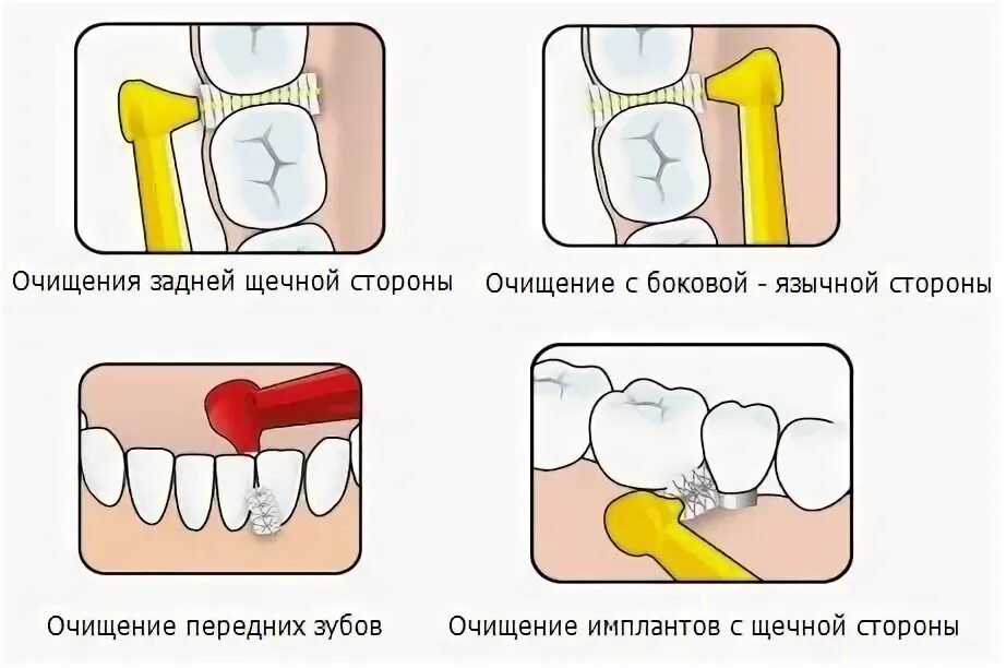 Аккуратно ввести. Ершики для чистки зубов схема. Как правильно чистить ершиком зубы. Интердентальные ершики для чистки зубов. Использование ершика для зубов.