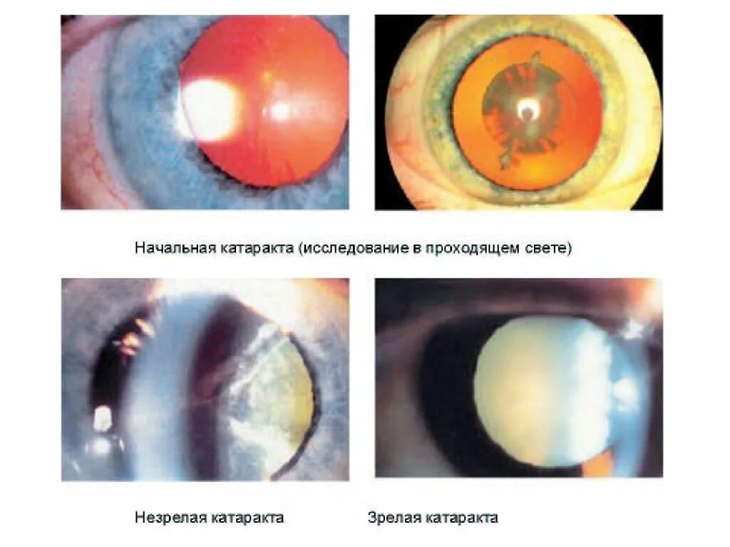 Начальная старческая катаракта. Переднекапсулярная катаракта. Начальная корковая катаракта. Катаракта биомикроскопия корковая. Корковая катаракта начальная стадия.