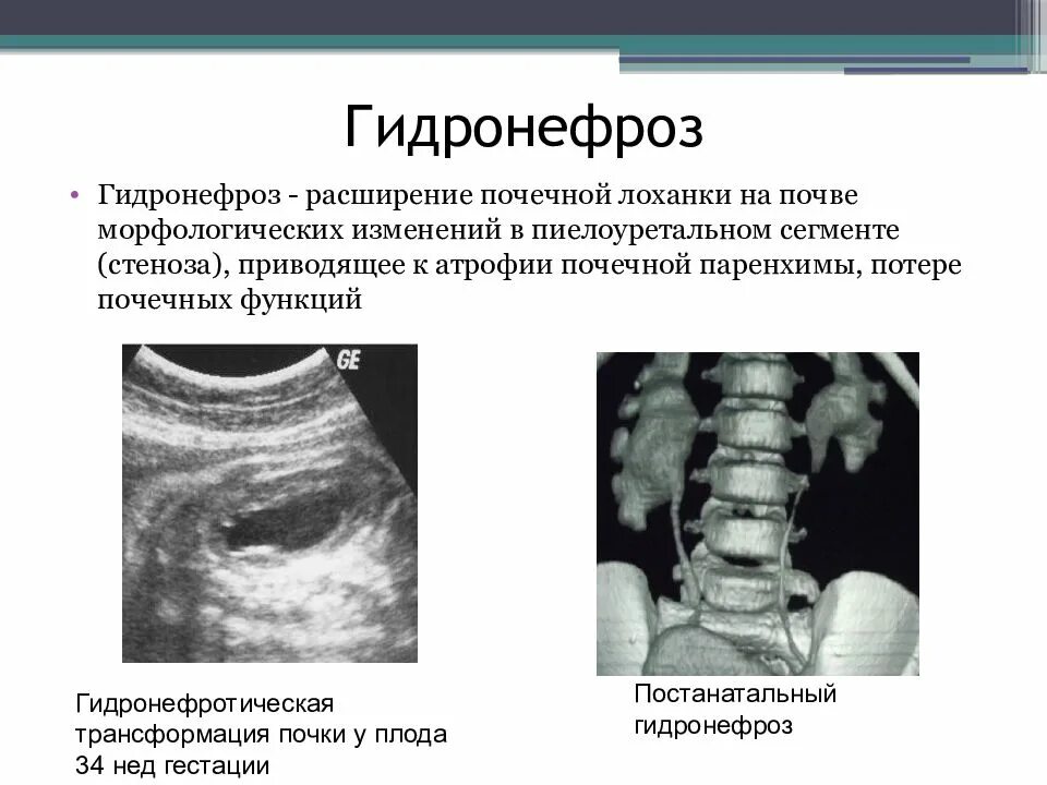 Что значит лоханка расширена. Врожденный гидронефроз (водянка почки). Расширение лоханки гидронефроз. Гидронефроз УЗИ критерии. Расширение лоханки почки.