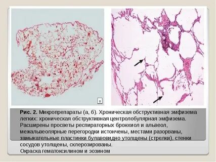 Эмфизема описание