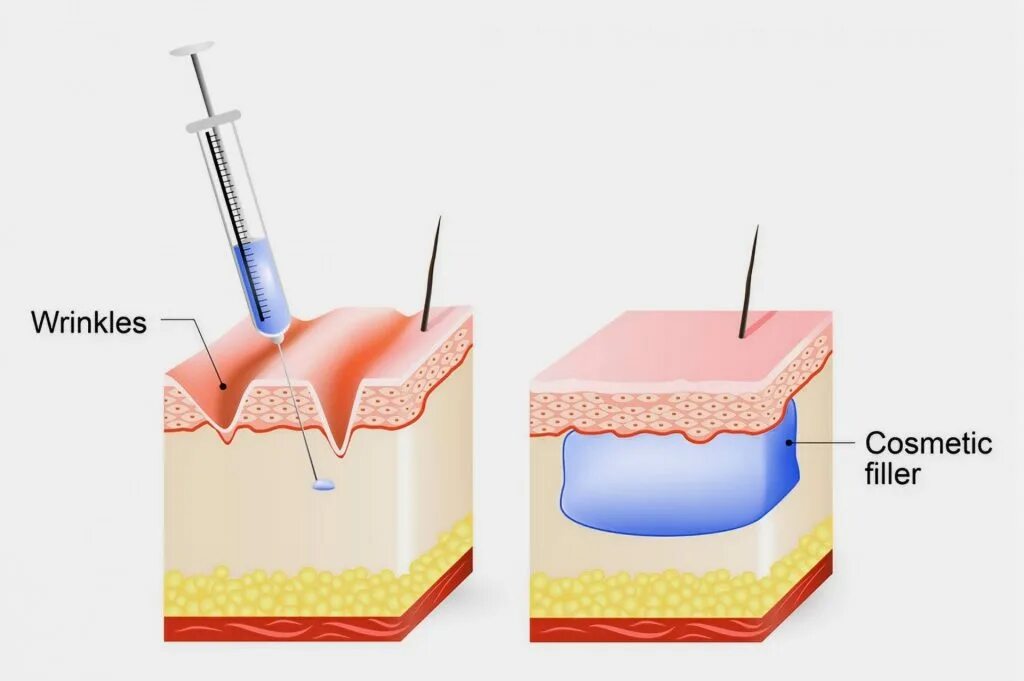 Как колоть филлер. Глубина введения филлера. Дермальные филлеры. Схема кожи для введения филлеров. Филлеры для контурной пластики.