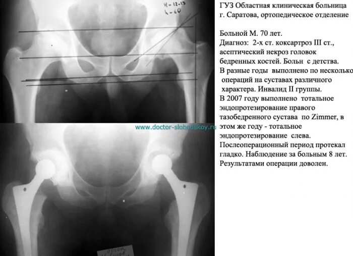 При коксартрозе дают инвалидность. Асептический некроз головки бедренной кости 4 ст. туннелизация тазобедренных сустава рентген. коксартроз инвалидность. асептический некроз головки тазобедренного сустава инвалидность.