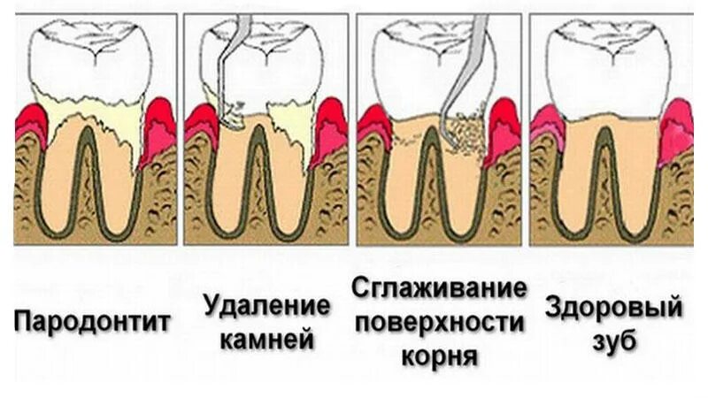 Как чистить зубы после удаления зуба