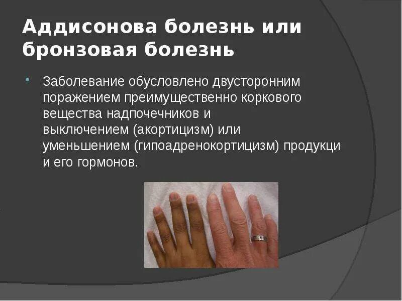 Аддисонова болезнь симптомы. Болезнь аддисона (гипокортицизм). аддисонова болезнь этиология. клинические симптомы болезни аддисона. болезнь аддисона тип наследования.
