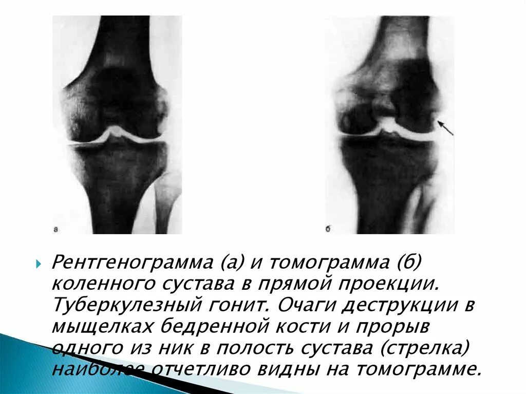 Костно-суставной туберкулез коленного сустава. Костный туберкулез коленного сустава. Костно-суставной туберкулез рентген стадии. Преартритическую фазу туберкулеза коленного сустава..