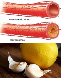 Средства от бляшек в сосудах
