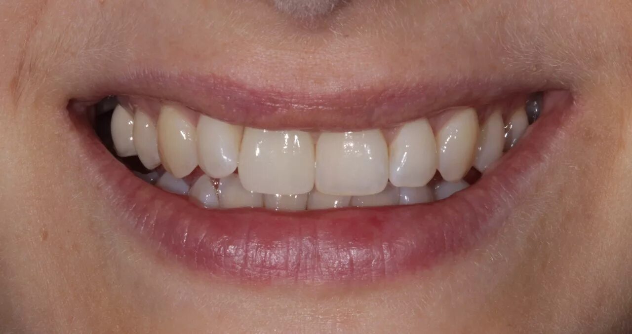 Zr02 оксид циркония керамика. Оксид циркония bl2. Диоксид циркониевая коронка. Циркон диоксид коронкой. Циркониевые коронки на передние зубы.