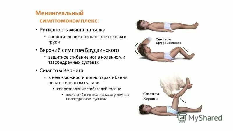 ригидность мышц ног. ригидность мышц ног. менингеальные симптомы в неврологии кернига брудзинского. симптом ригидности затылочных мышц. менингеальные симптомы симптом брудзинского.