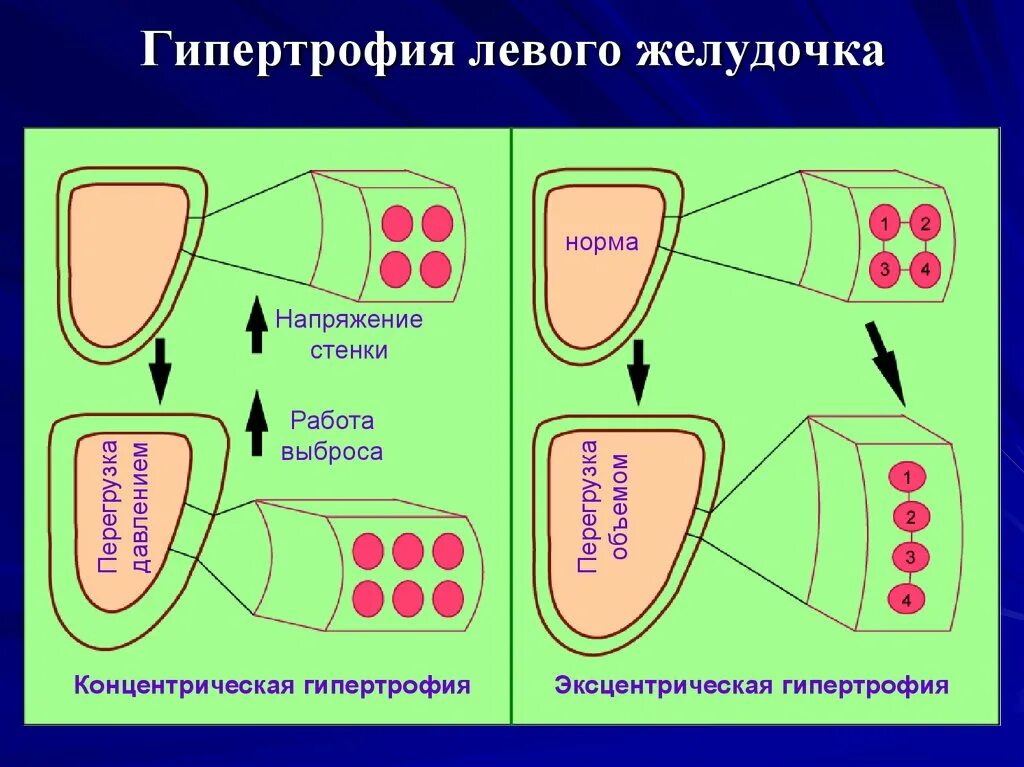 Гипертрофия что это. Концентрическая гипертрофия. Концентрическая и эксцентрическая гипертрофия. Концентрическая и эксцентрическая гипертрофия левого желудочка. Эксцентрический Тип гипертрофии миокарда.