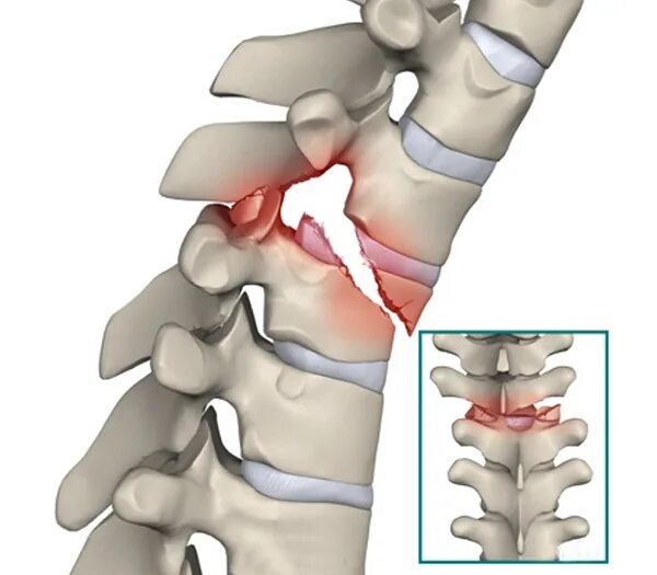 Компрессионный перелом позвоночника л5. Оскольчатый перелом позвоночника. Осколочный компрессионный перелом позвоночника. Неосложненный компрессионный перелом.