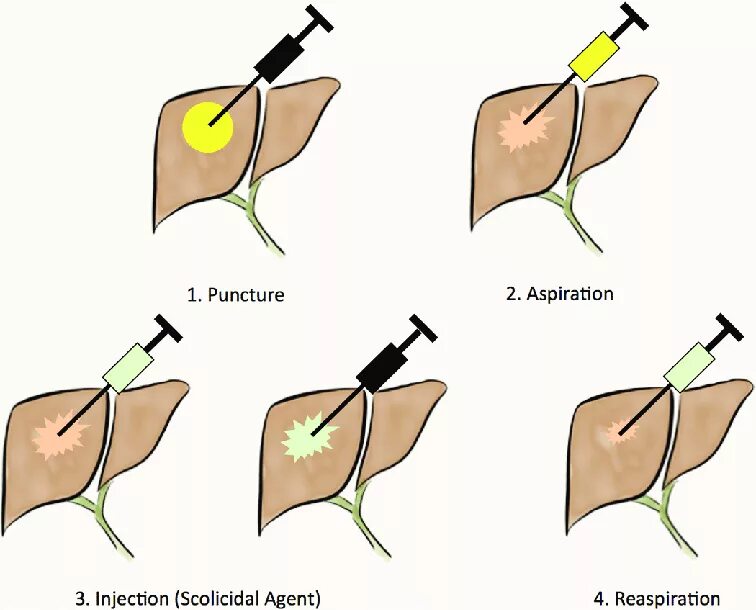Into procedure