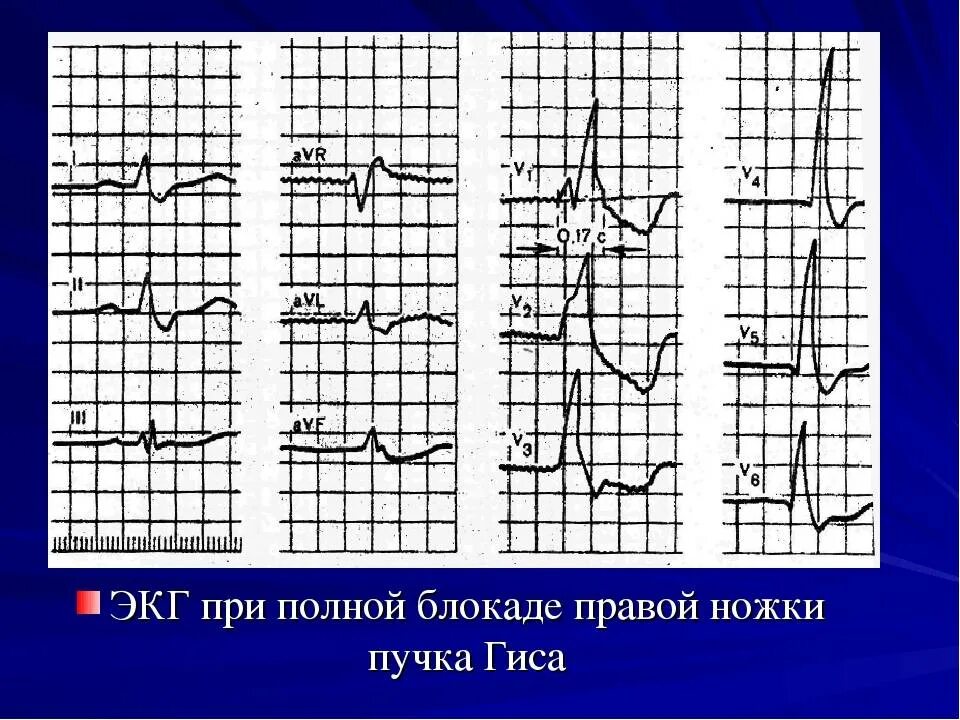 Признаки неполной блокады. Блокада правой ножки пучка Гиса на ЭКГ. ЭКГ при блокаде правой ножки пучка Гиса ЭКГ. Блокада ПНПГ на ЭКГ. Блокада ЛНПГ на ЭКГ.