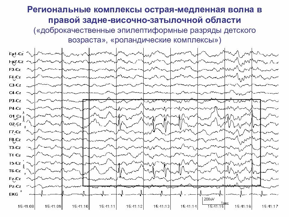 Острые волны на ээг у ребенка