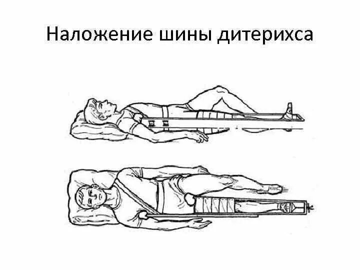 Наложение крамера. Наложение шины дитерихса. транспортная иммобилизация перелома бедра шиной дитерихса. шина дитерихса при переломе бедра. порядок наложения шины дитерихса.
