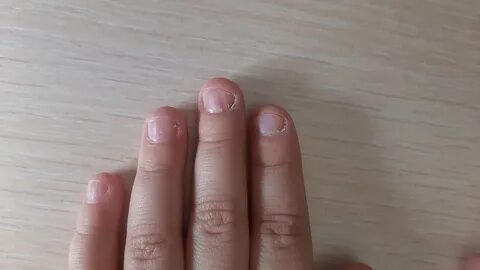 Отходит ногтевая пластина