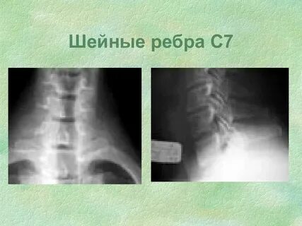 Шейные ребра