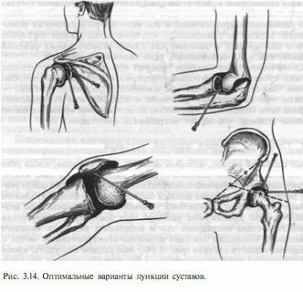 Суставы ран