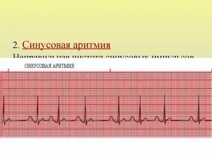 Нарушение автоматизма синусовая аритмия номотопный водитель