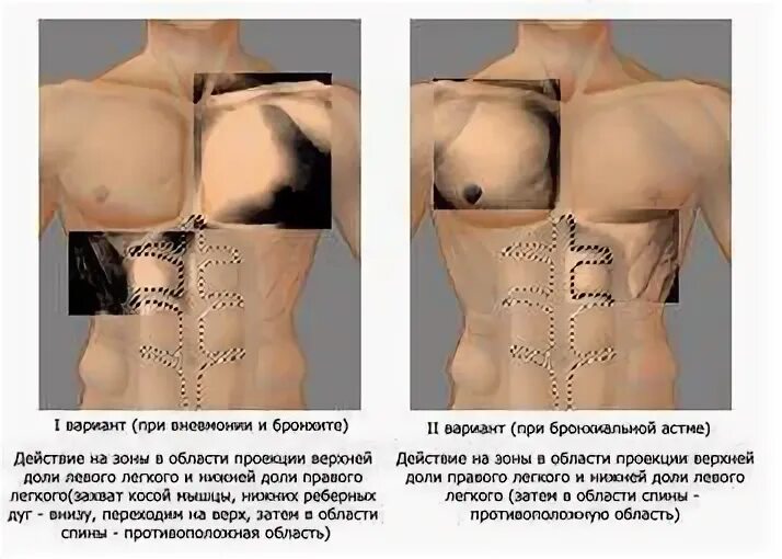 Бронхофония точки. Массаж грудной клетки. Интенсивный массаж ассиметричных зон. Методика имаз. Вибрационный массаж грудной клетки для детей.