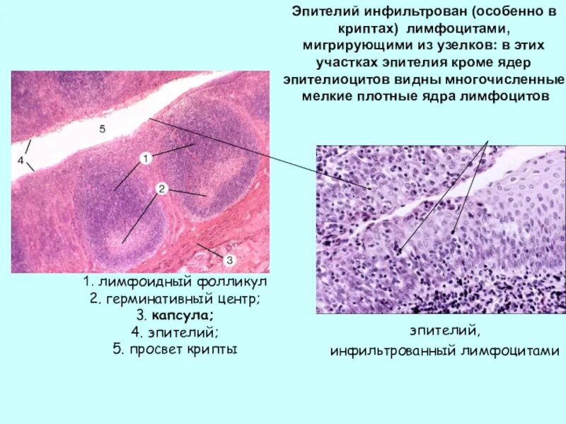 Лимфоидная инфильтрация что это. Строение герминативного эпителия. Инфильтрованный эпителий. Инфильтрация эпителия крипт лимфоцитами.
