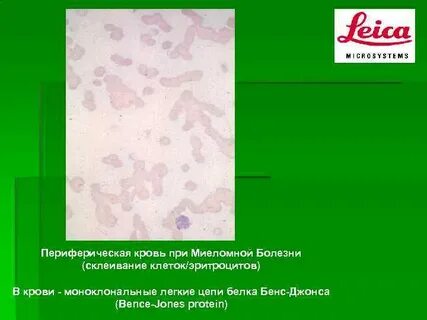 Миеломная болезнь бенс джонса