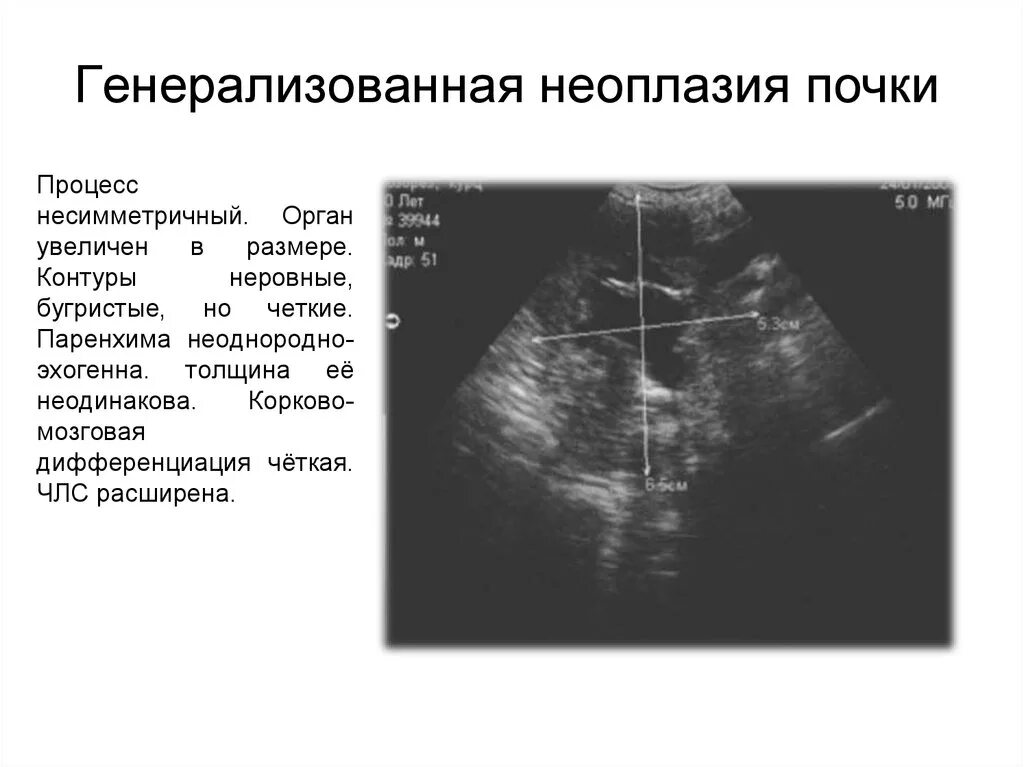 Члс расширена. Бугристый контур почки на УЗИ. Расширение ЧЛС почек на УЗИ. Расширение чашечно-лоханочной системы почек на УЗИ норма. Паренхима почки на УЗИ.