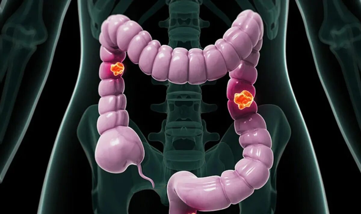 Симптомы рака кишки. Опухоль опухоль ободочной кишки. Опухоль сигмовидной кишки.